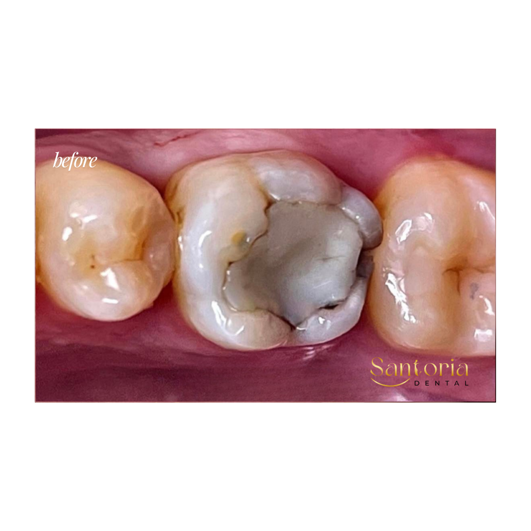 Biomimetic Restoration before treatment