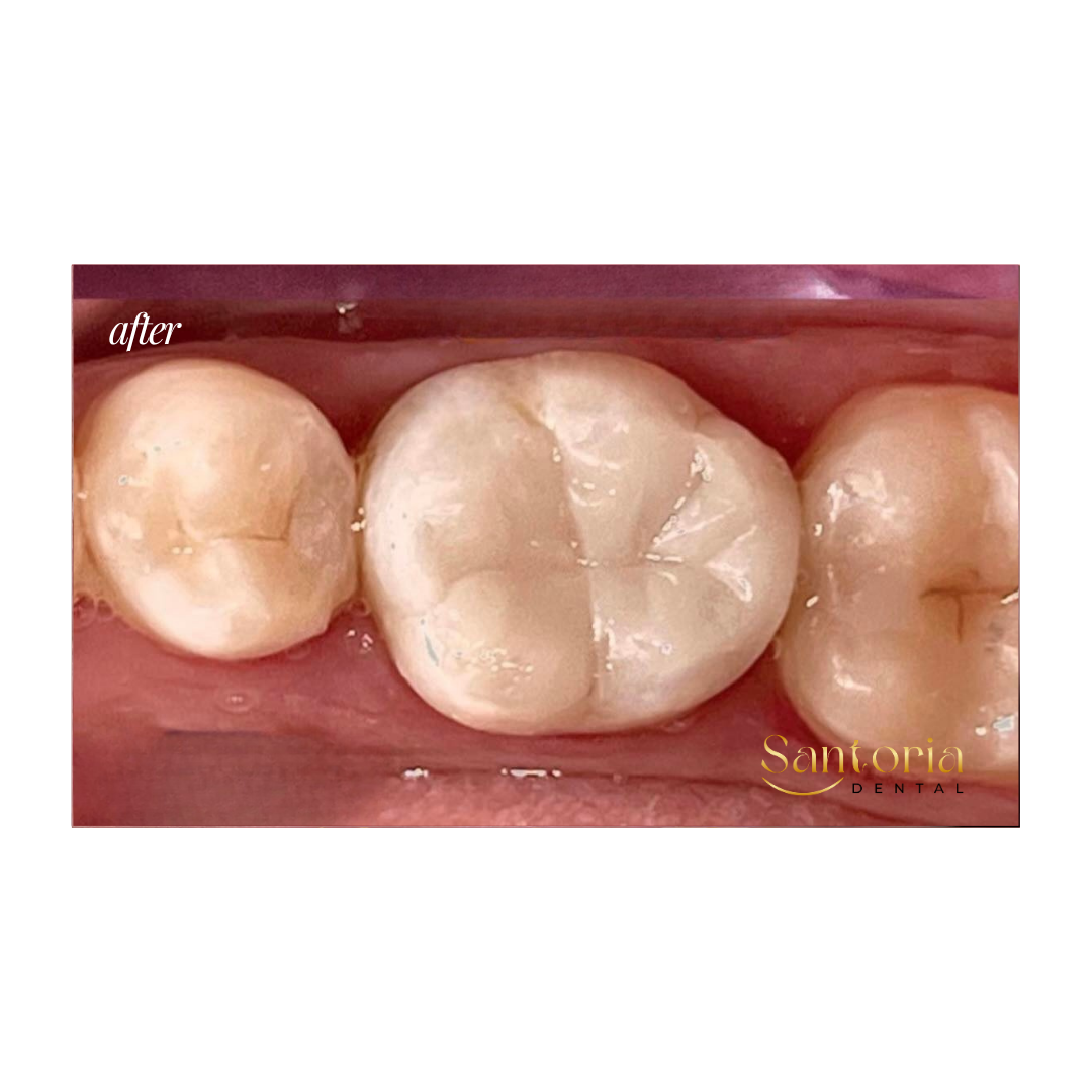 Biomimetic Restoration after treatment