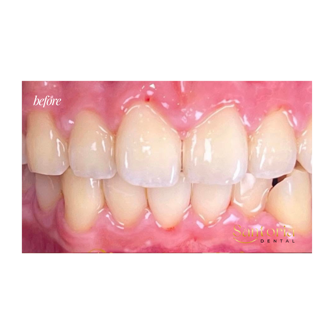 Clear aligner before treatment