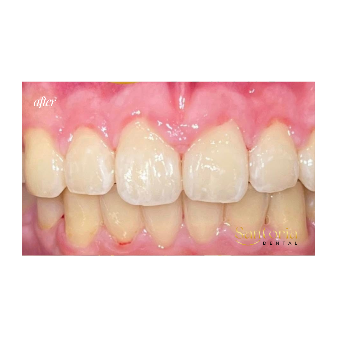Clear aligner after treatment