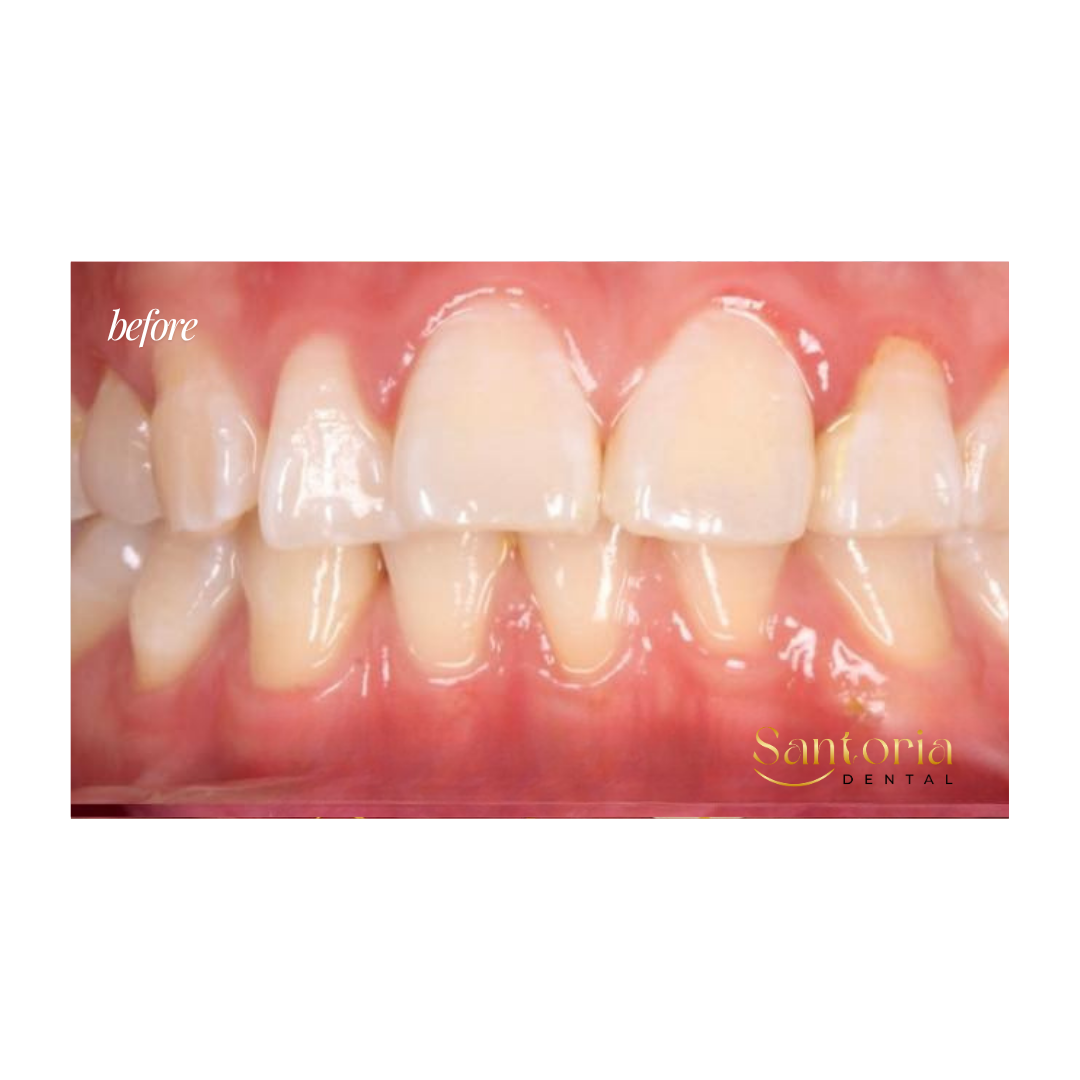 Conventional metal braces before treatment