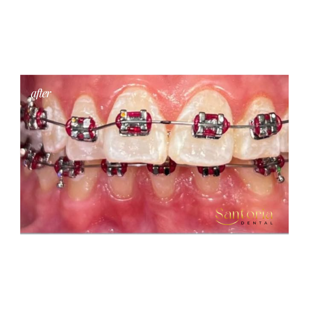 Conventional metal braces after treatment