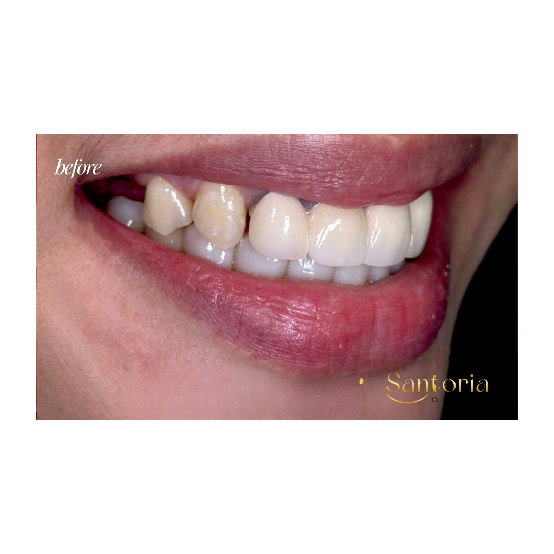 Dental bridge before treatment