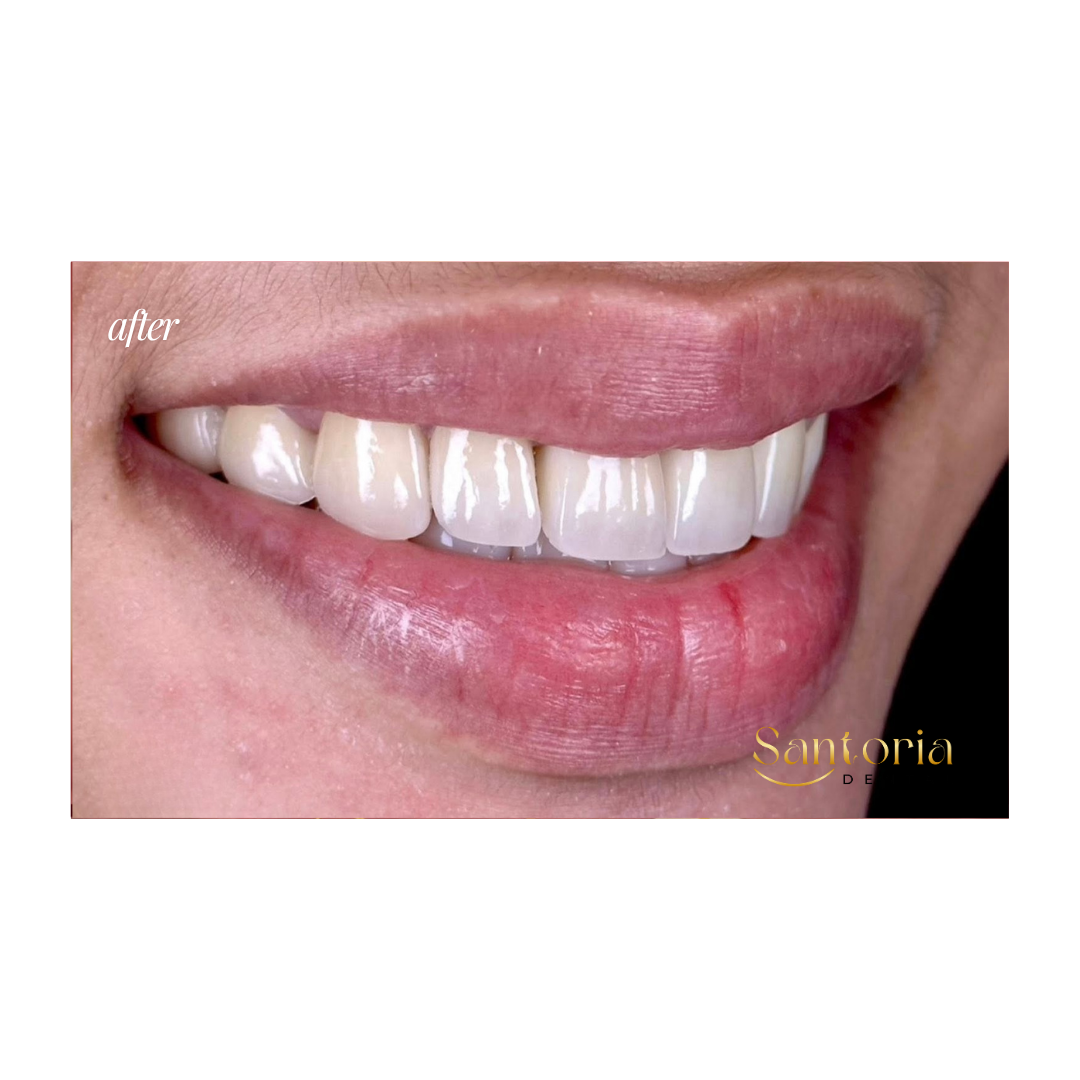 Dental bridge after treatment