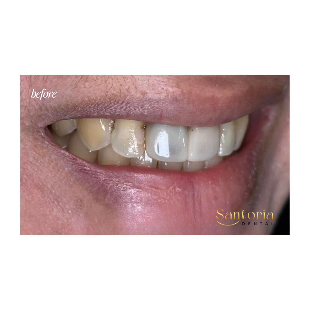 Dental crown before treatment