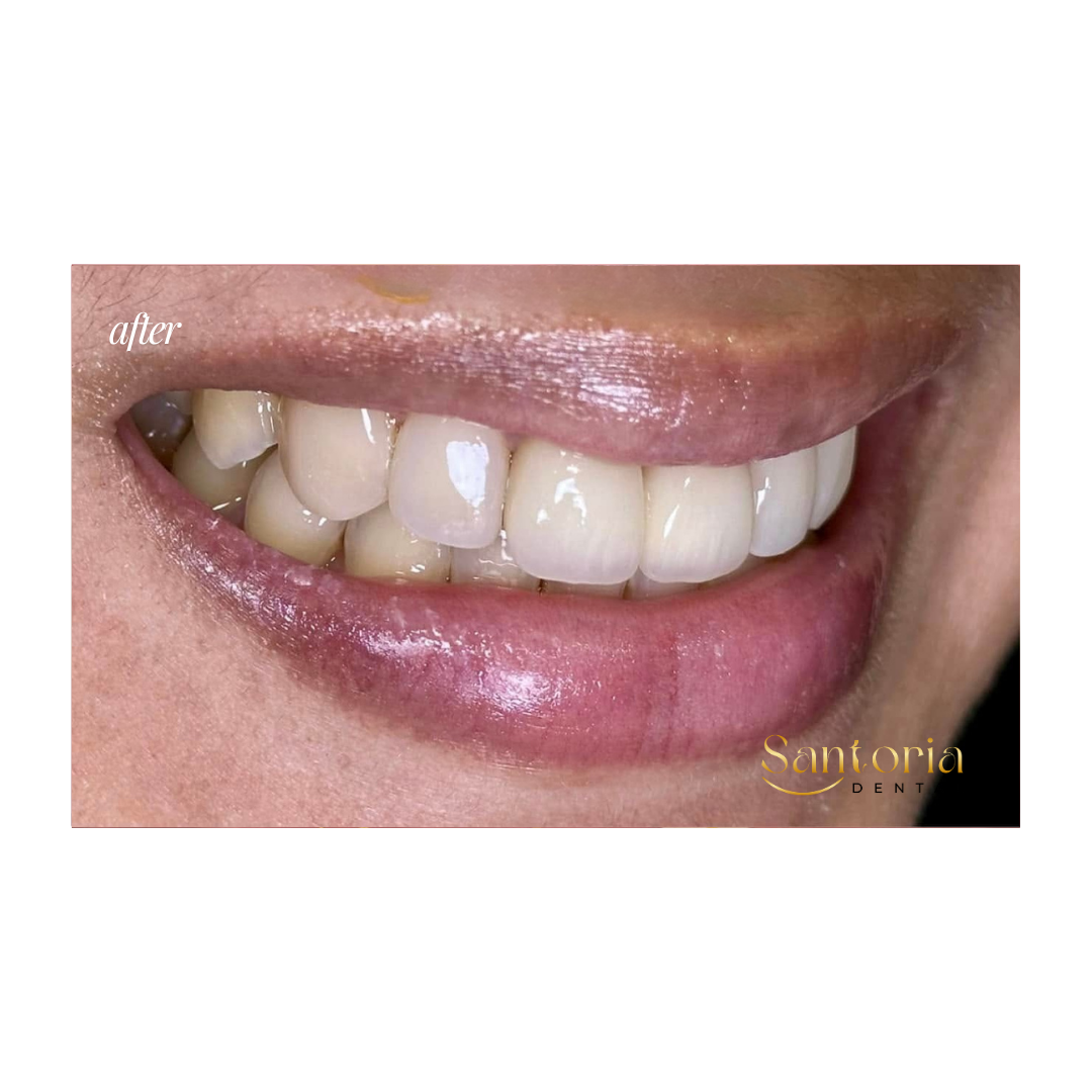 Dental crown after treatment