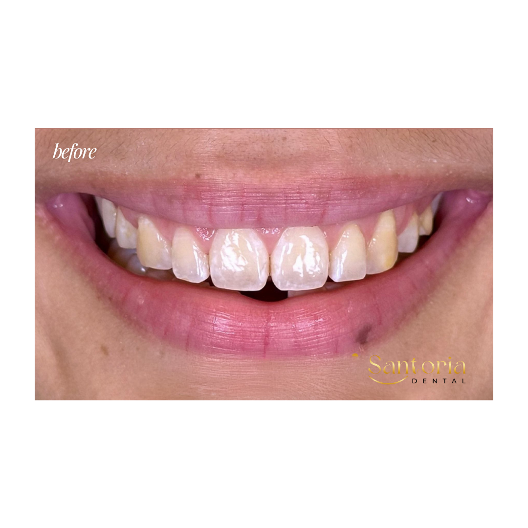 Dental veneers before treatment