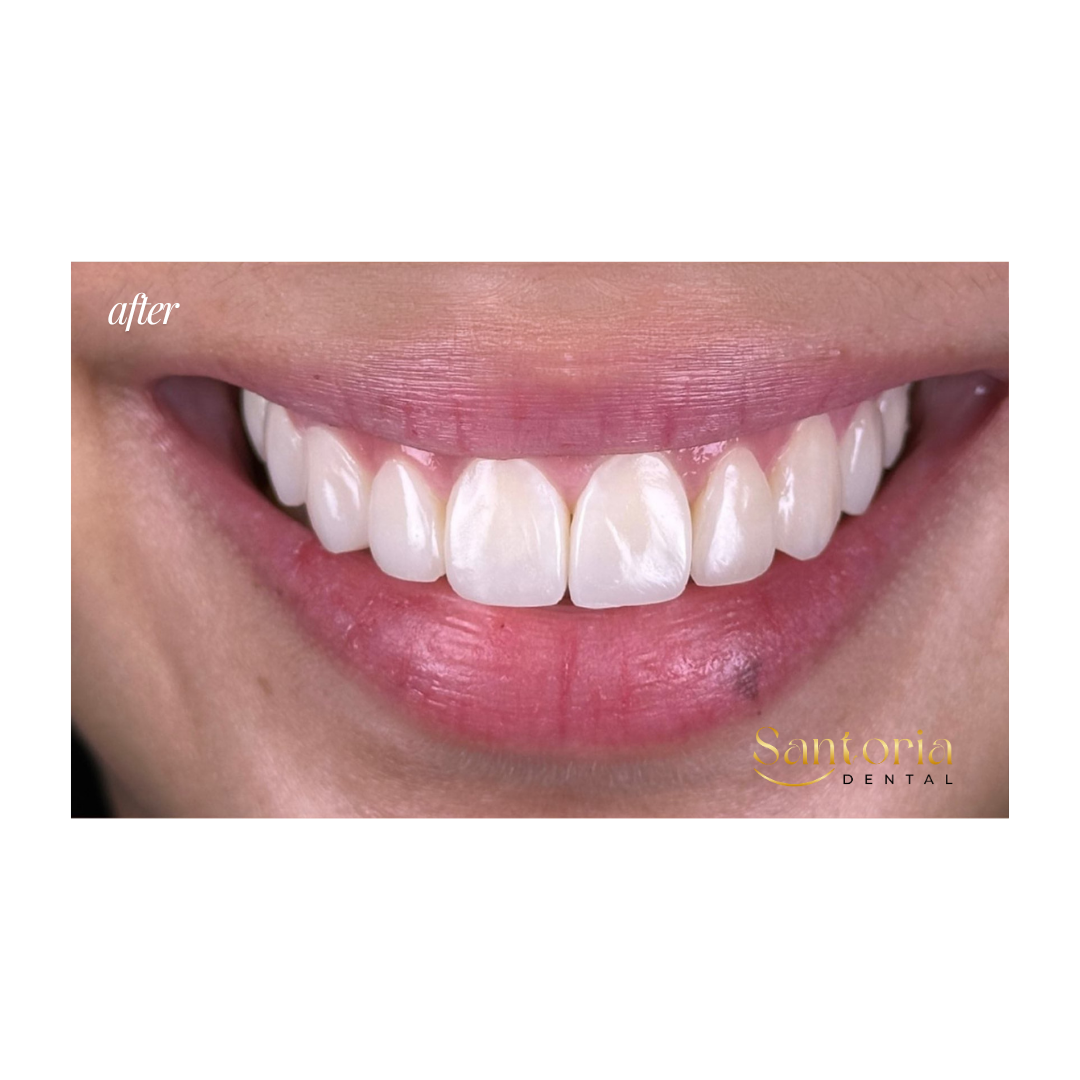 Dental veneers after treatment