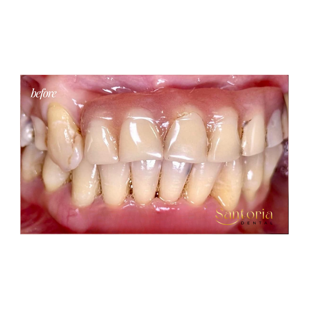 Denture before treatment