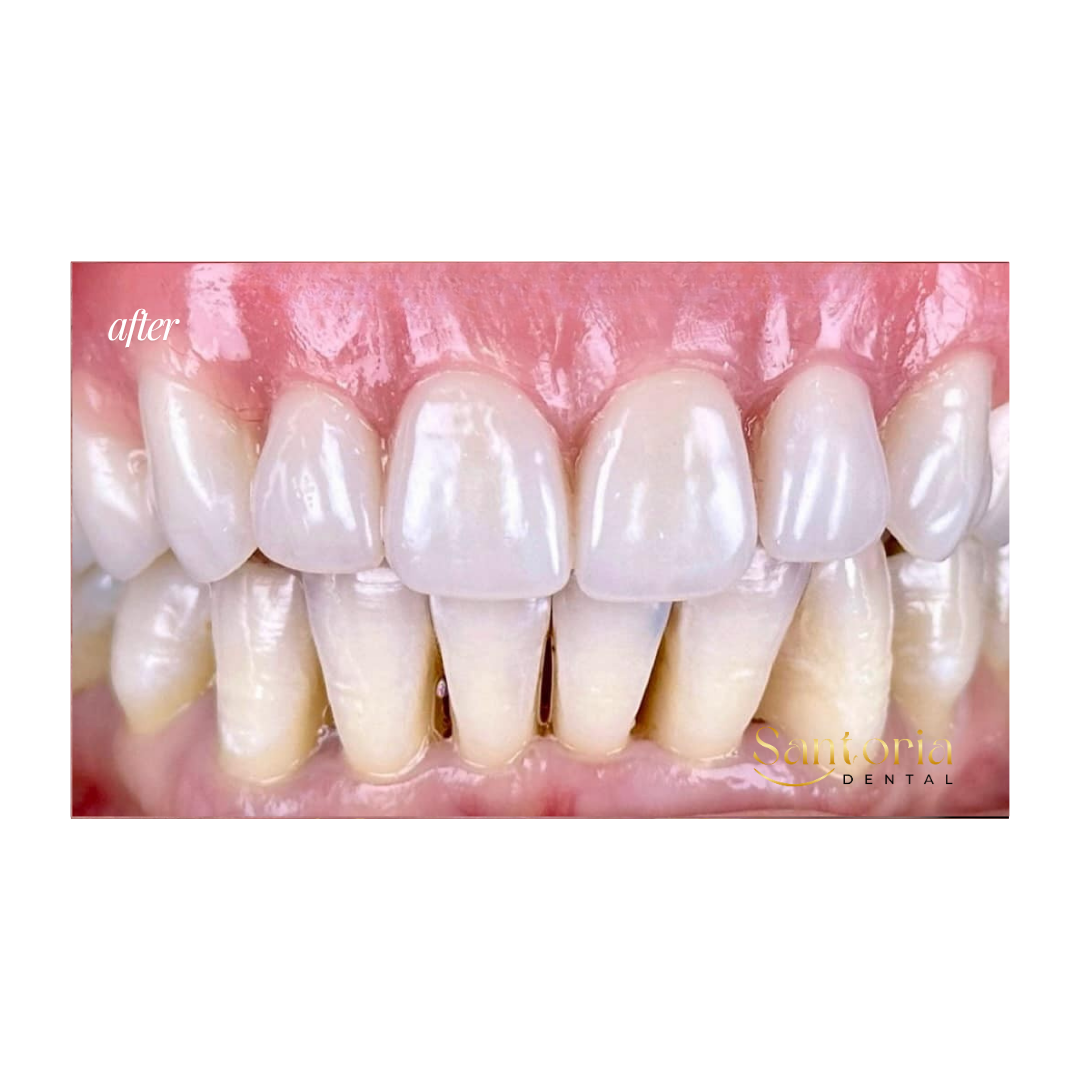 Denture after treatment