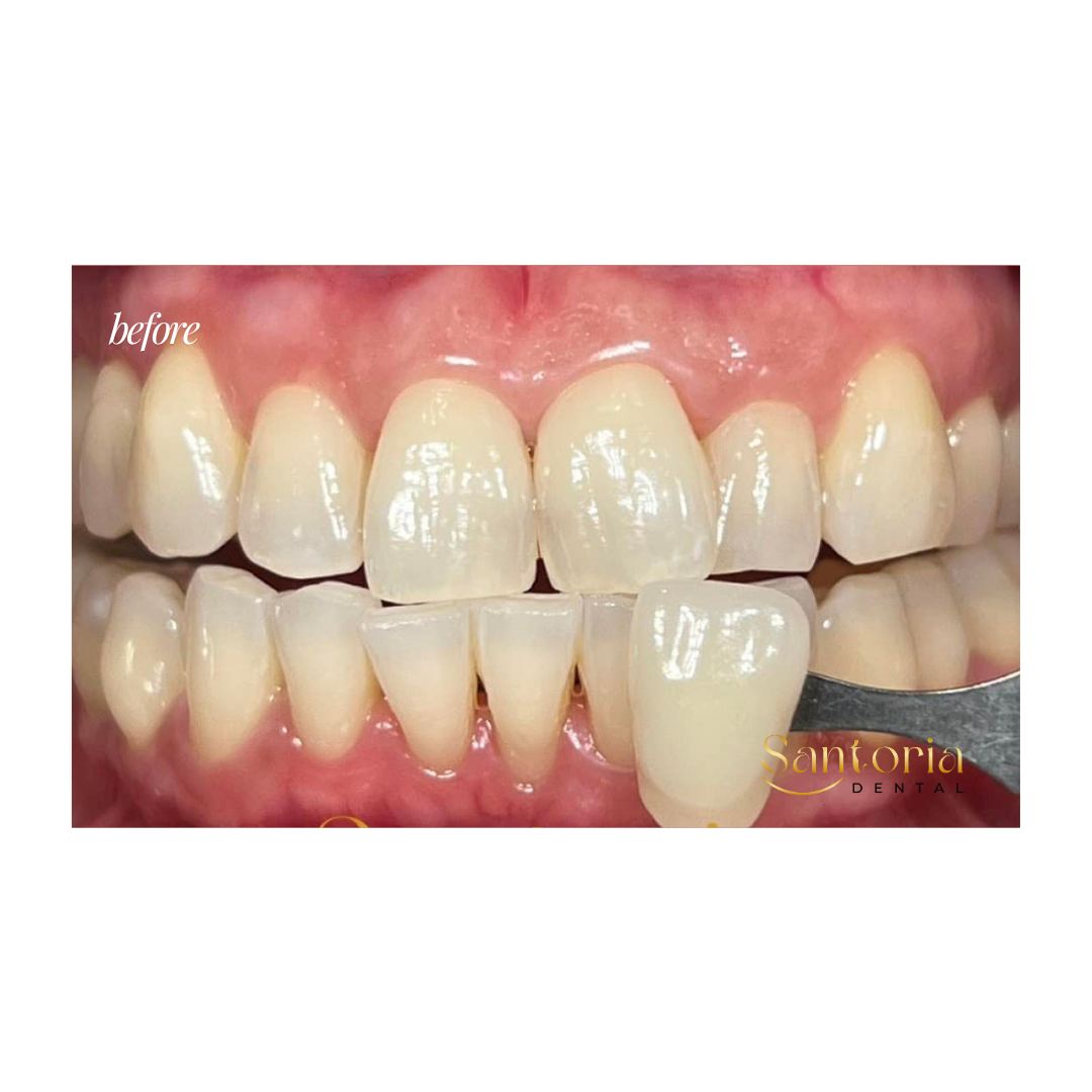 Teeth whitening before treatment