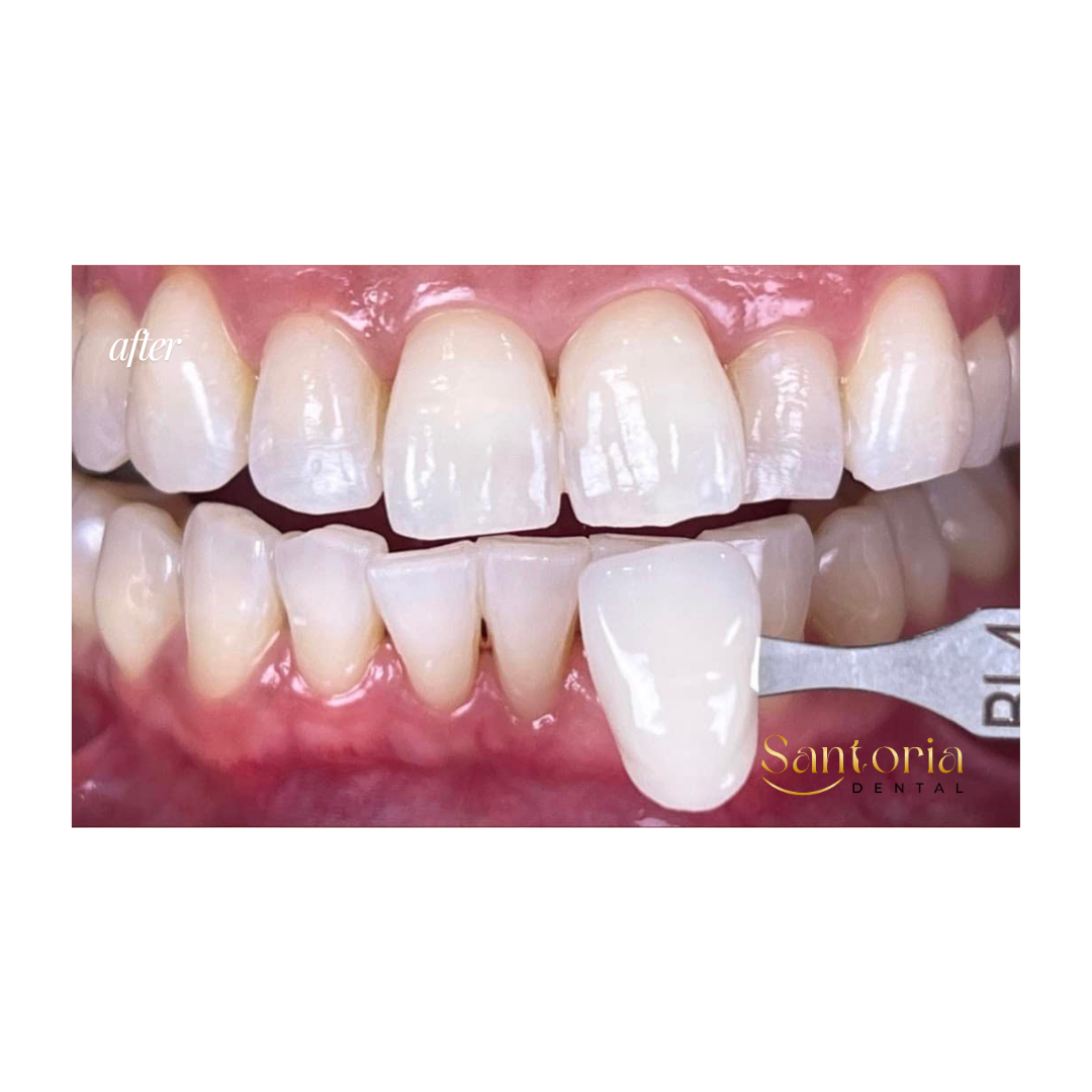 Teeth whitening after treatment