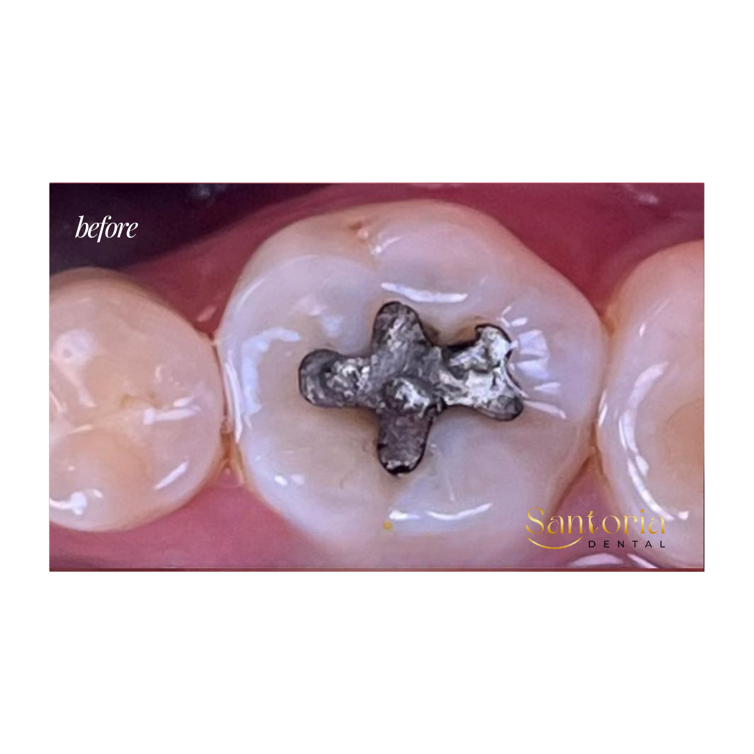 Tooth restoration before treatment