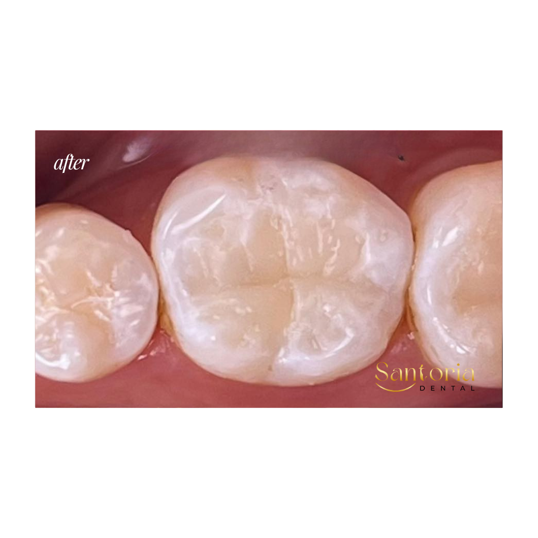 Tooth restoration after treatment